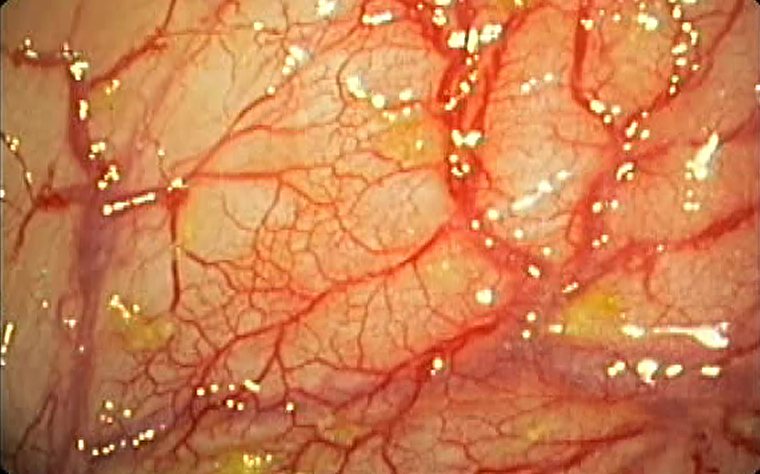 Ангиодисплазия кишечника (толстой кишки)